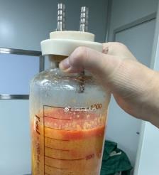 开封水动力吸脂手术要做多久？